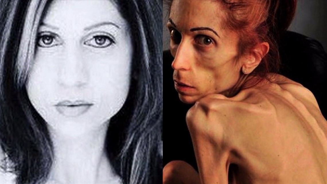 Denver Hospital To Accept Pound Anorexic Woman Fox