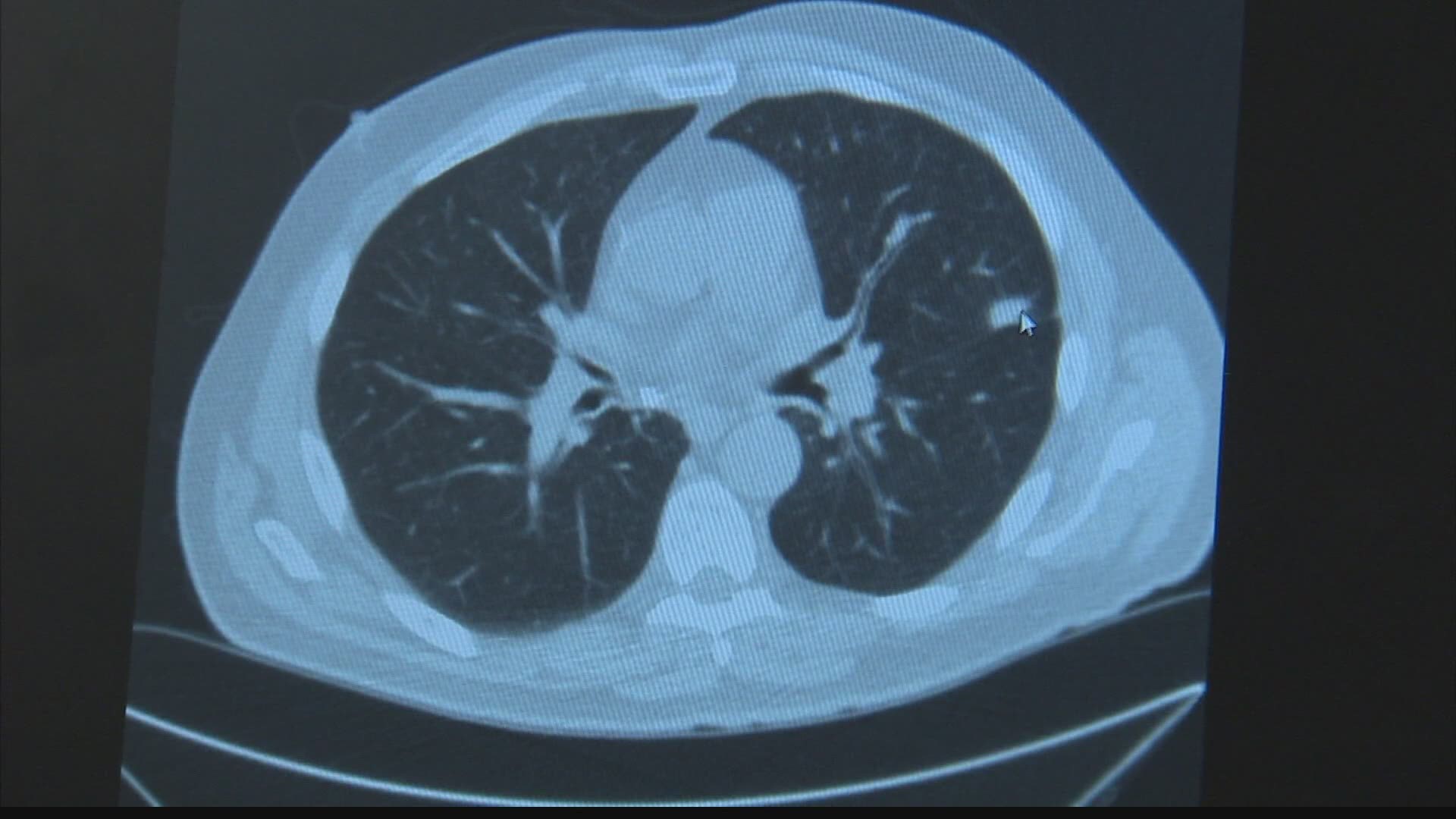 Check Up Low Dose Ct Scan Detects Lung Cancer Early In Some
