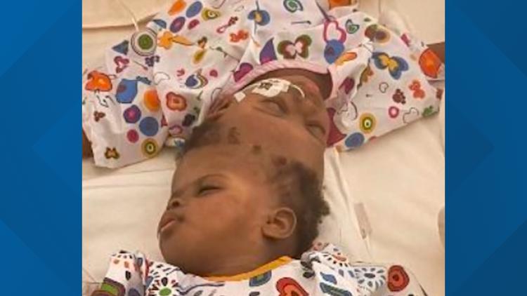 Conjoined twins surgically separated using cutting-edge VR tech, medical charity says