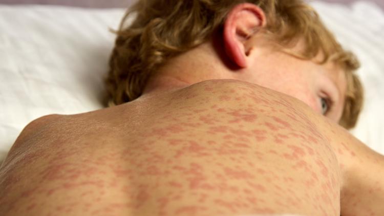 CDC: Nearly 1,000 US measles cases confirmed in first two months of 2026