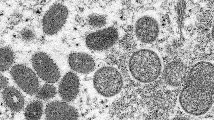 Man in Columbus area diagnosed with monkeypox