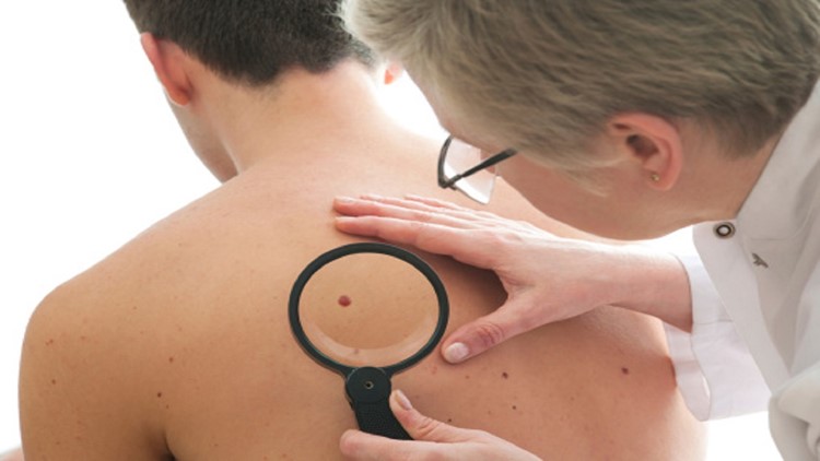 Allina Health offering free skin cancer screenings for Melanoma Monday