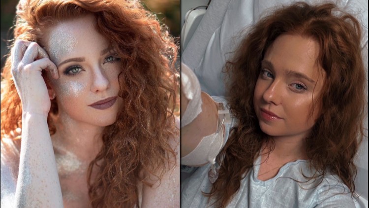 MN model shares struggle with bowel disease on social media, hoping to help others feel less alone