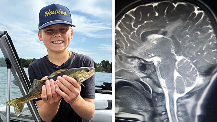 9-year-old Minnesota boy survives an arrow through his brain