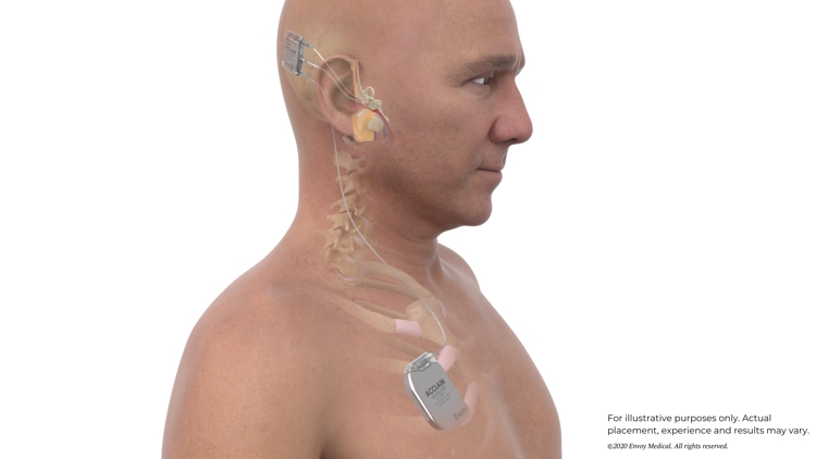 White Bear Lake company debuts world's first fully implanted cochlear device