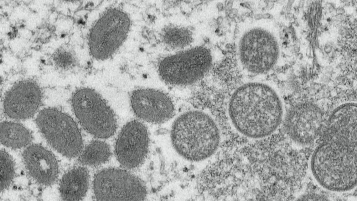 WHO declares monkeypox outbreak a global emergency - Vimarsana News