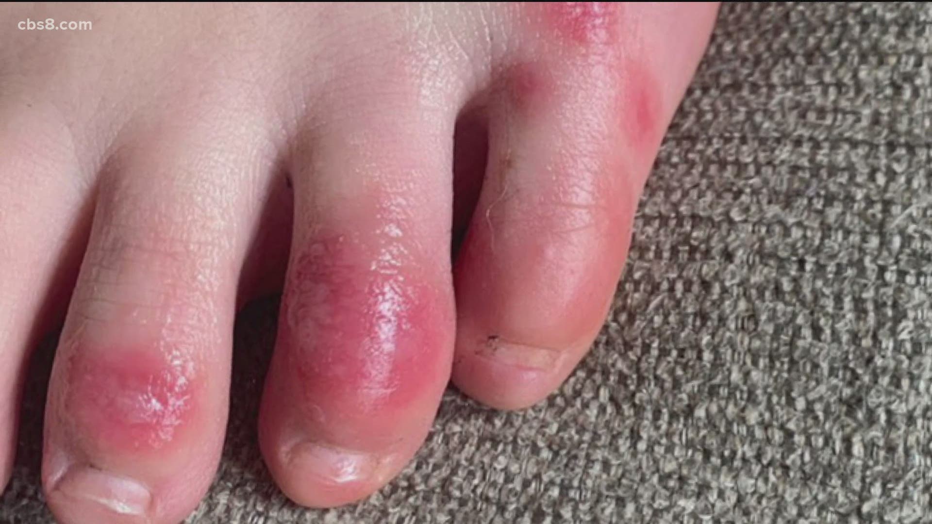 Skin doctors say coronavirus symptoms are popping up in unusual places like toes.