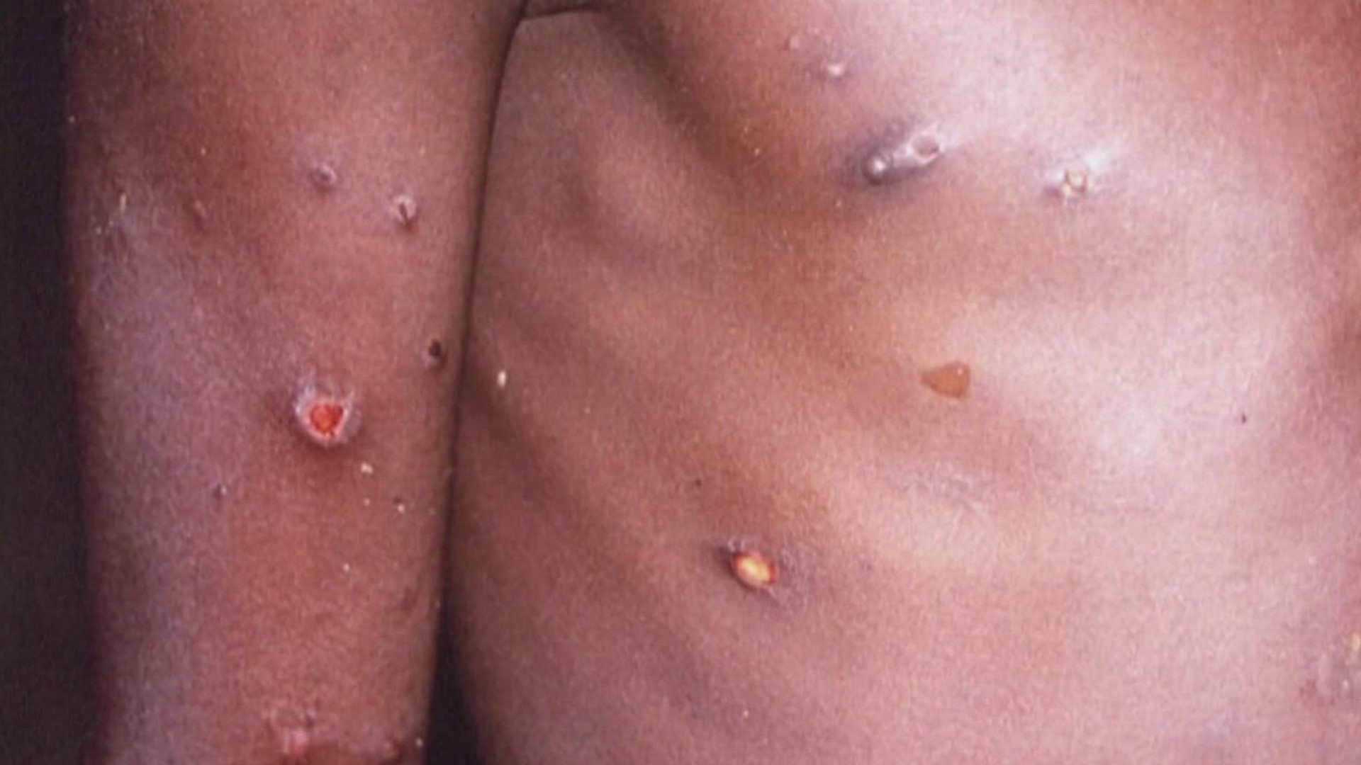 As of today, there are more than 4,600 cases of monkeypox in the United States. In Arkansas, there are 4 confirmed cases. But, it's not as infectious as COVID.