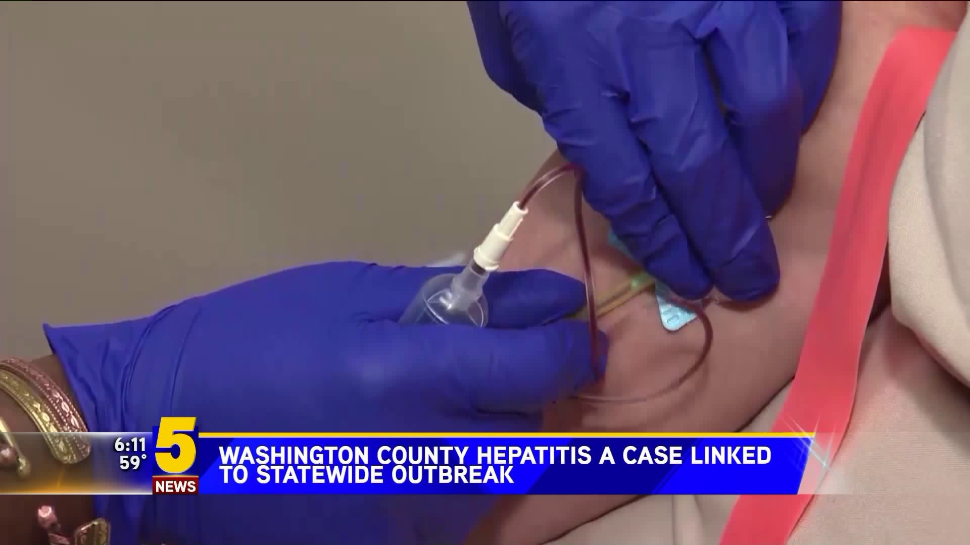 Washington County Hep A Case Linked To Statewide Outbreak