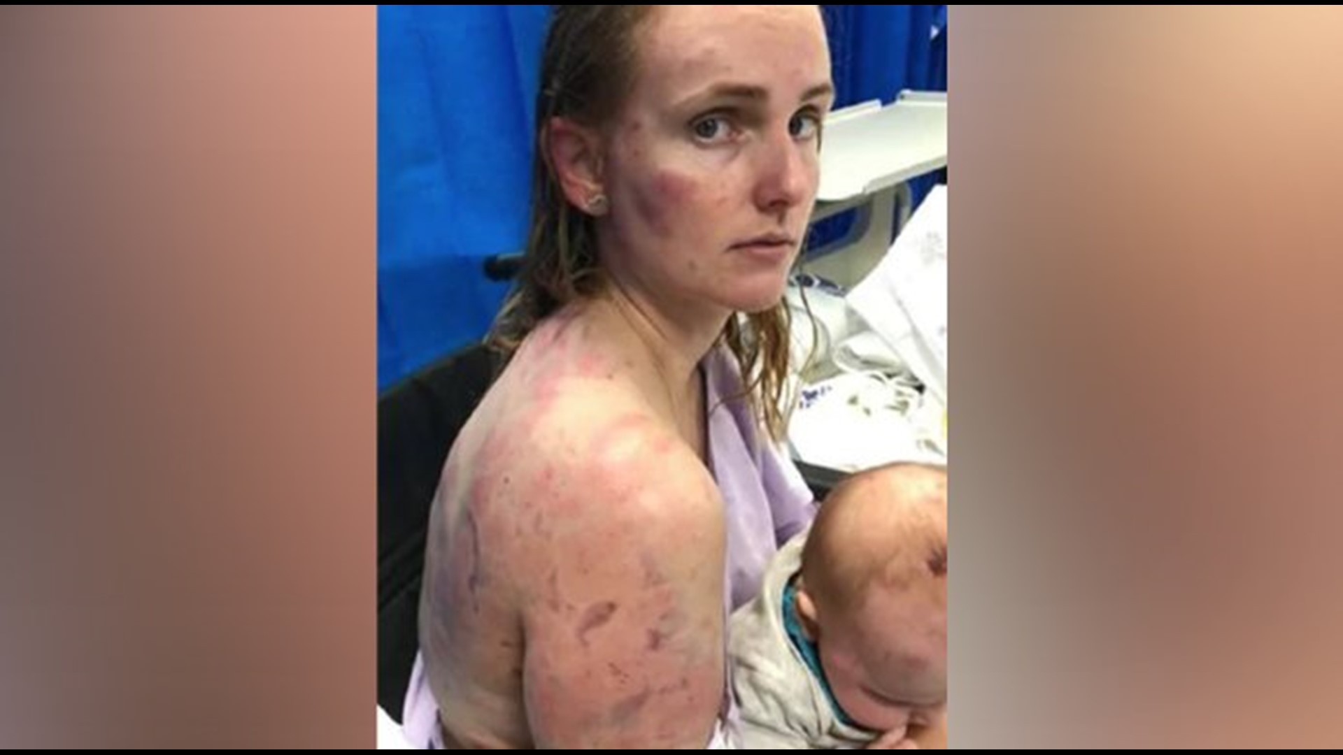 Mom Who Shielded Infant Daughter From Tennis Ball-Sized Hail Shares ...