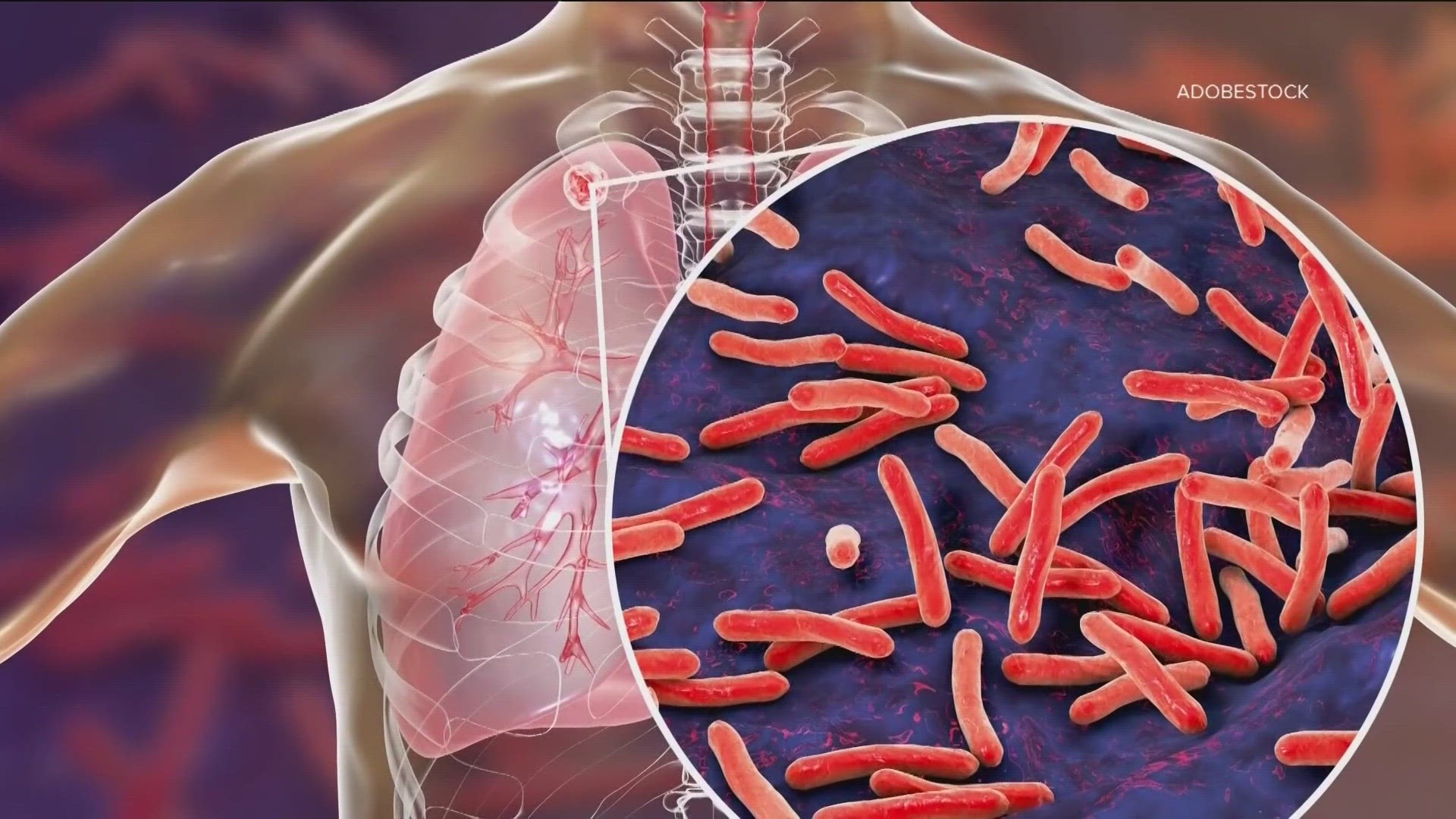 Tuberculosis: Causes, Symptoms, Diagnosis & Treatment