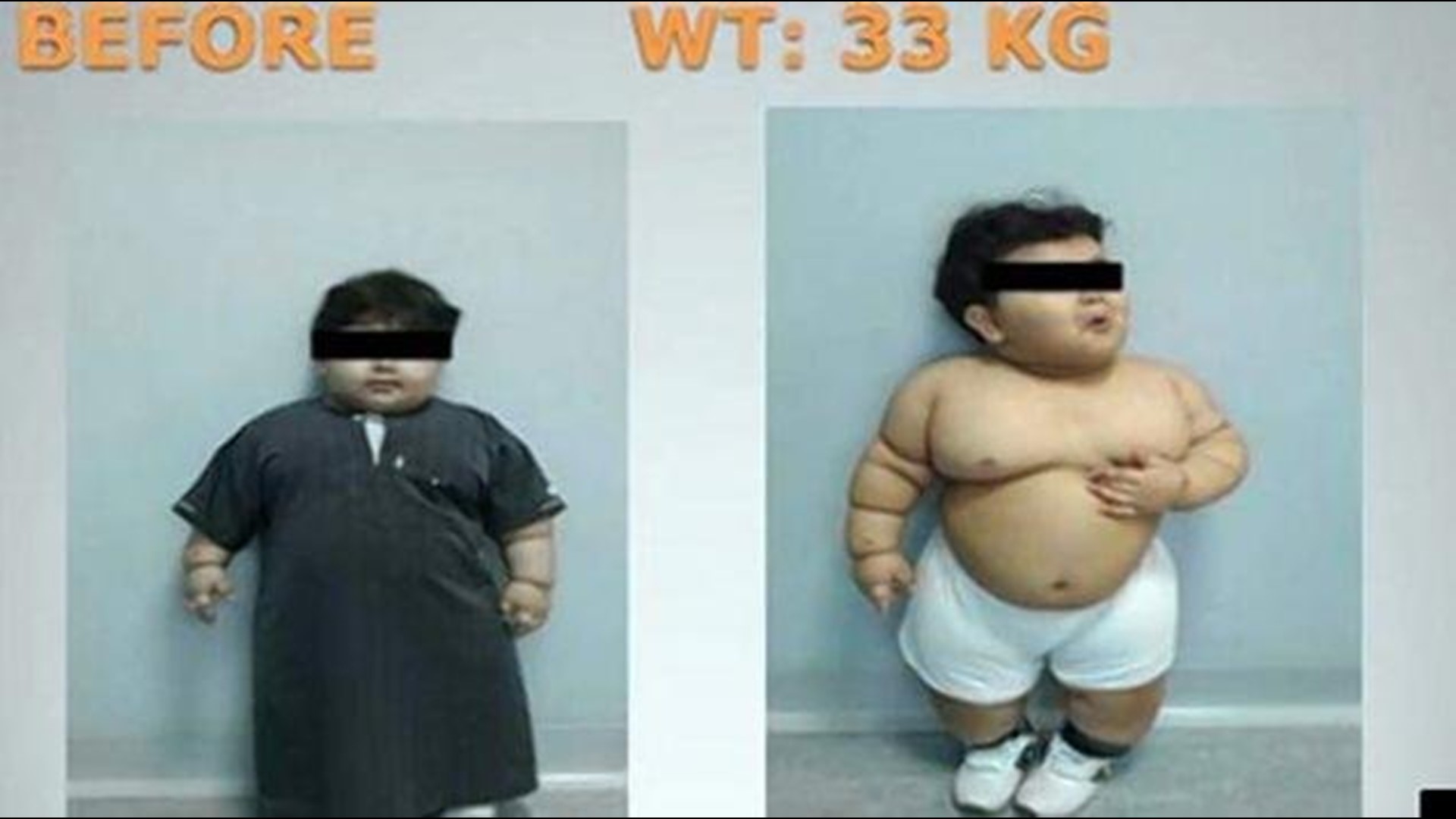2YearOld Gets Weight Loss Surgery