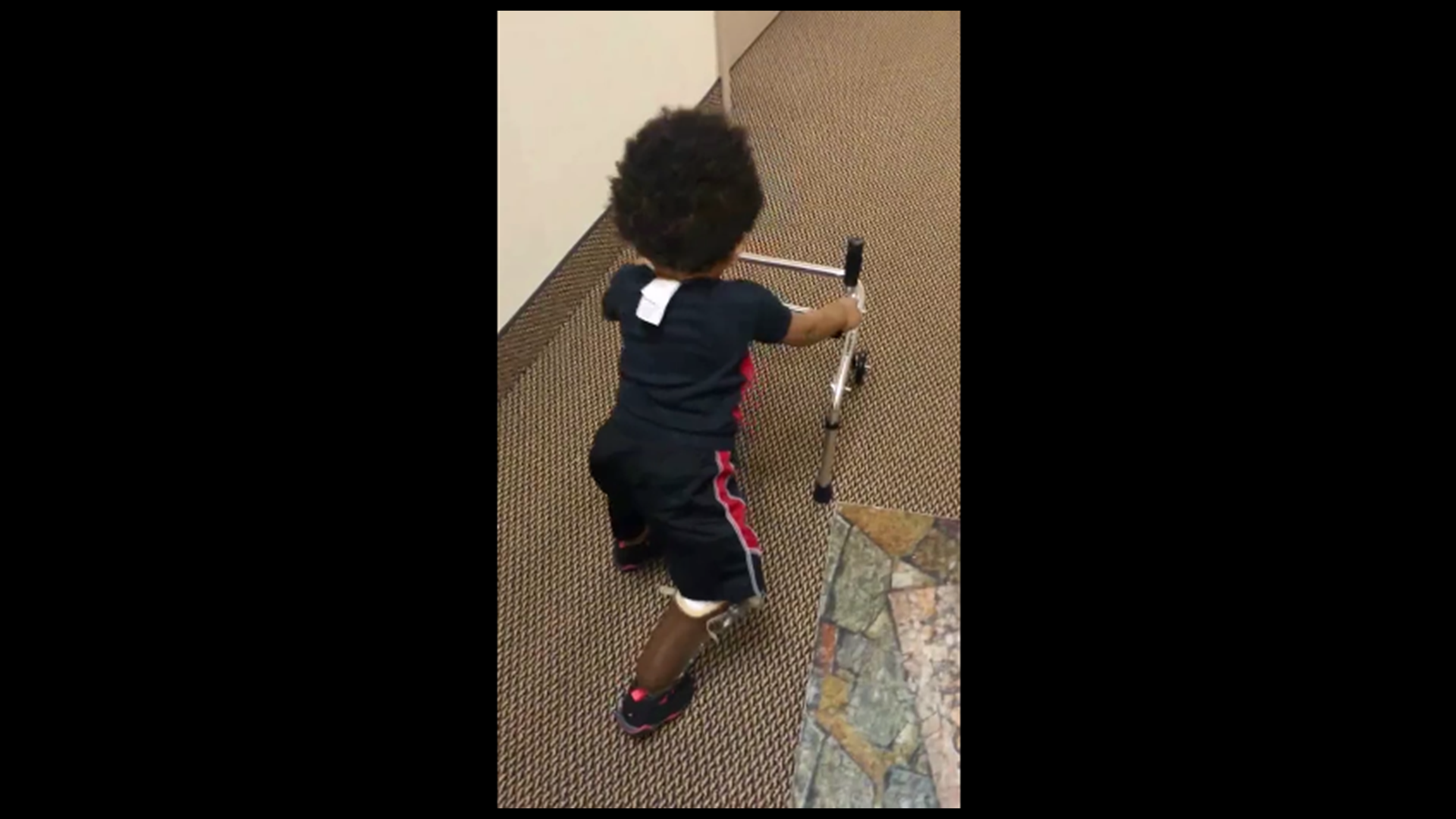 VIDEO 2YearOld Amputee Walks For The First Time