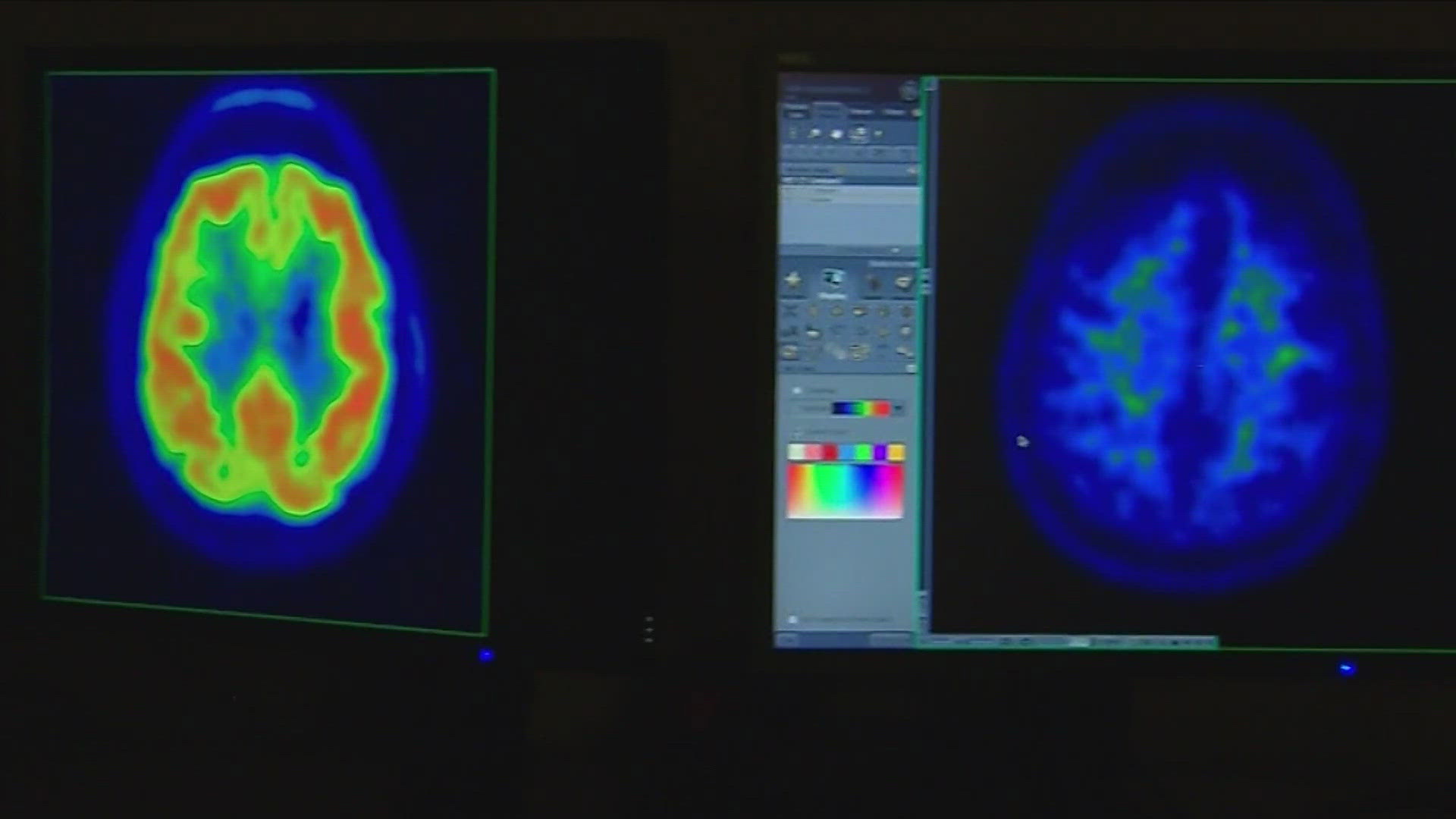 A combination of two blood tests could catch 90% of early dementia in patients, a new study shows.