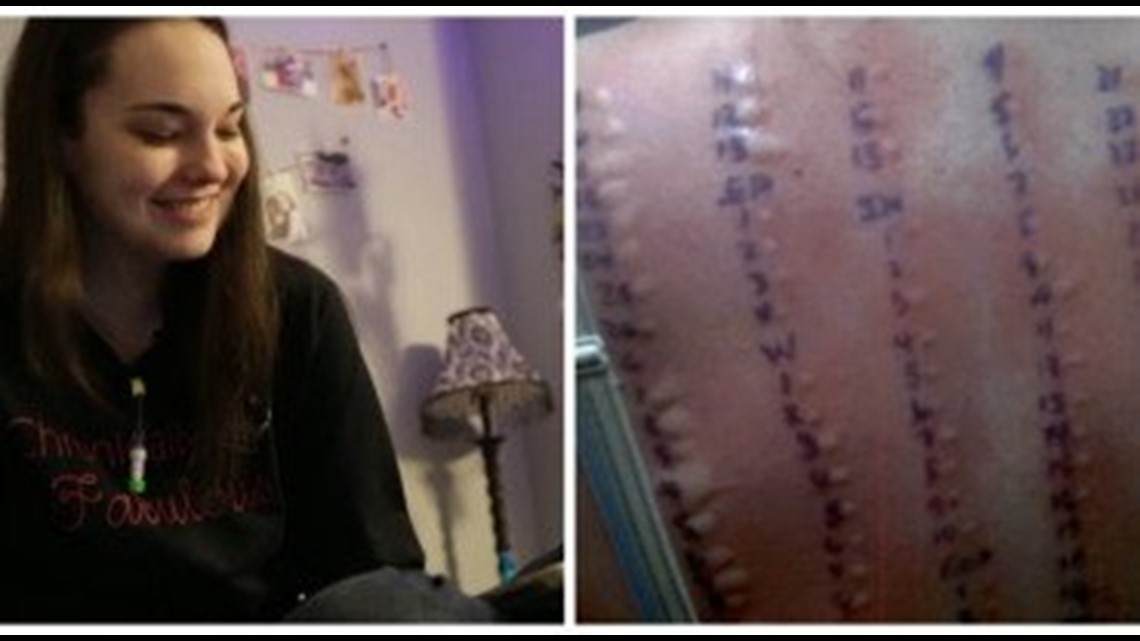 ‘Bubble Girl’ Is Allergic To Life