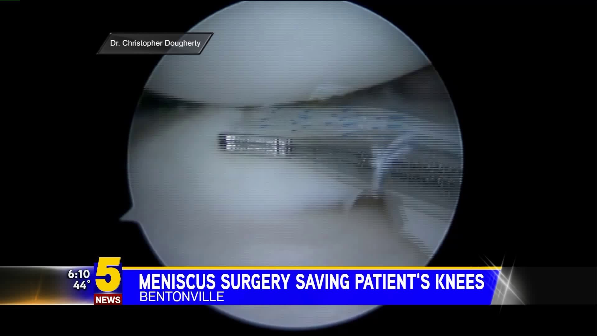 Saving Patients Knees