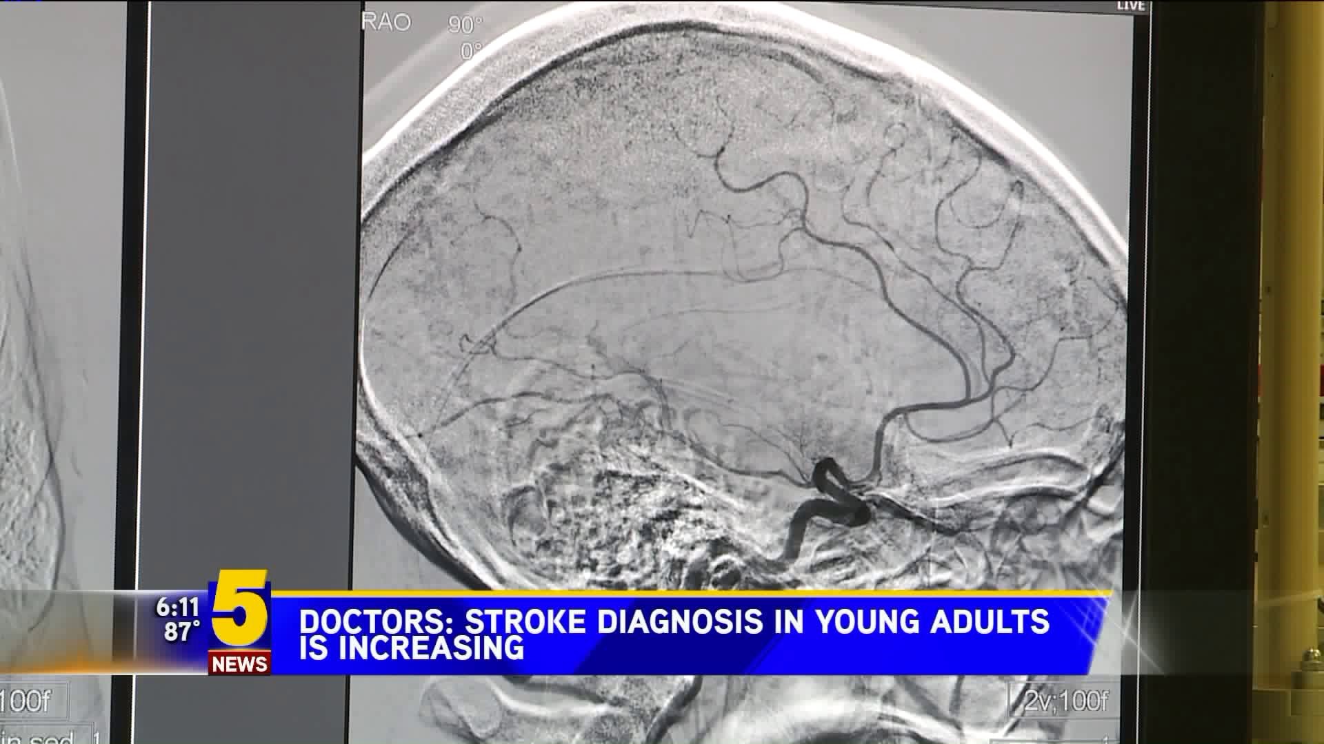 Strokes In Young Adults