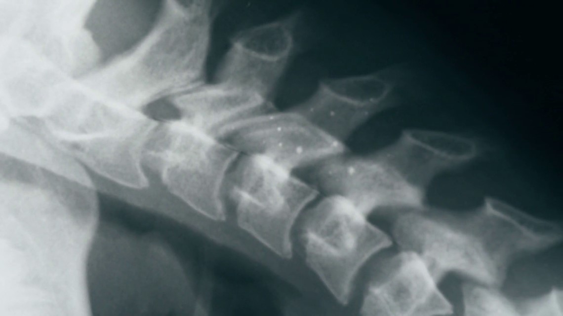 Healthy Living: Understanding Osteoporosis
