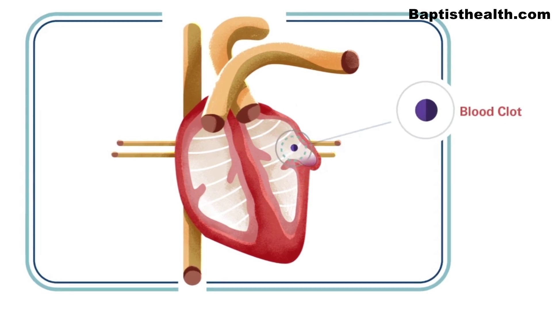 Cardiologist Doctor Hussam Hawamdeh offers a procedure that he says can change the lives of a-fib patients.