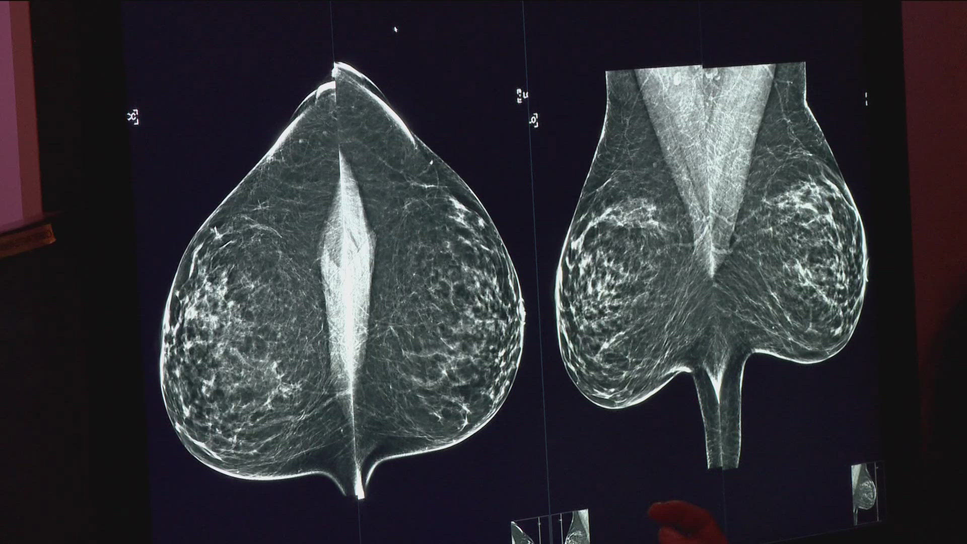 Breast cancer is the second most diagnosed cancer in American women, experts say.