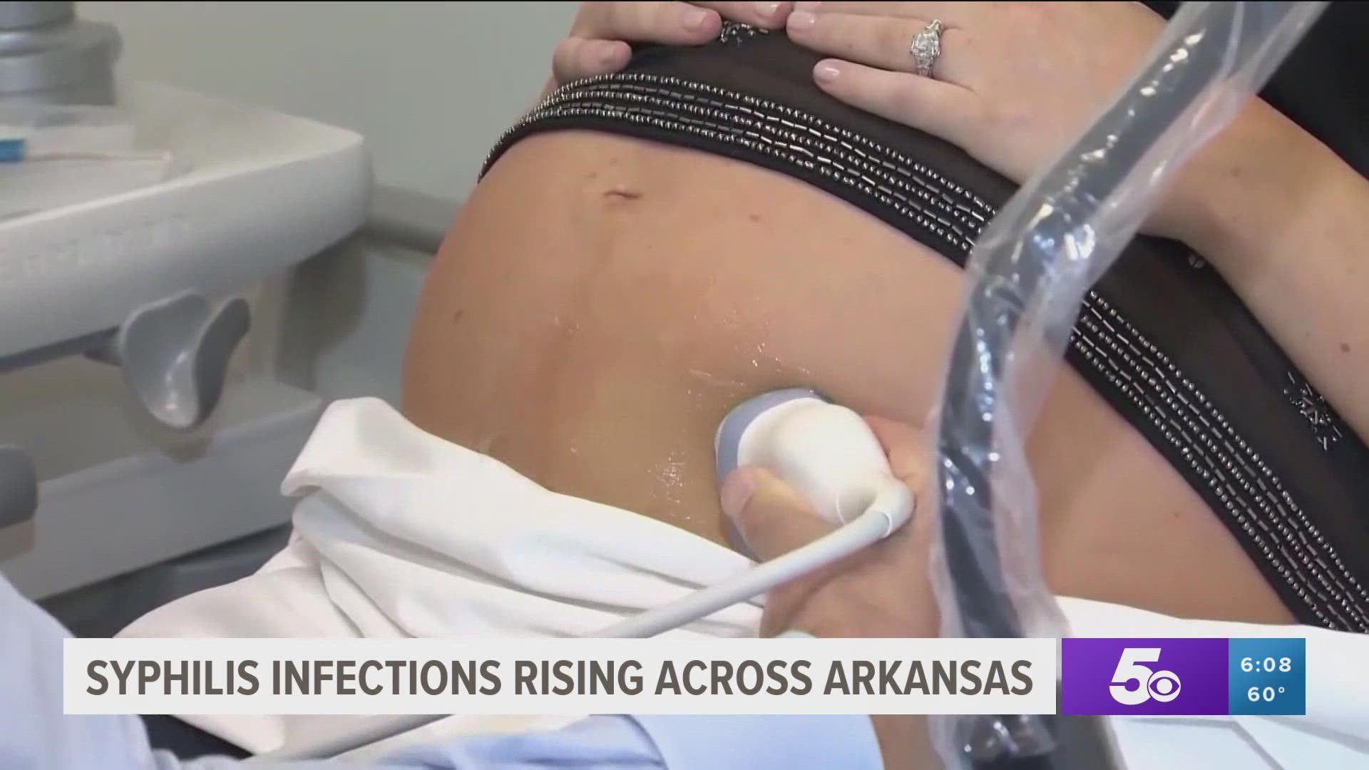Arkansas is seeing a spike in the number of syphilis infections, especially in women. The ADH says pregnant women who are infected should seek treatment immediately.