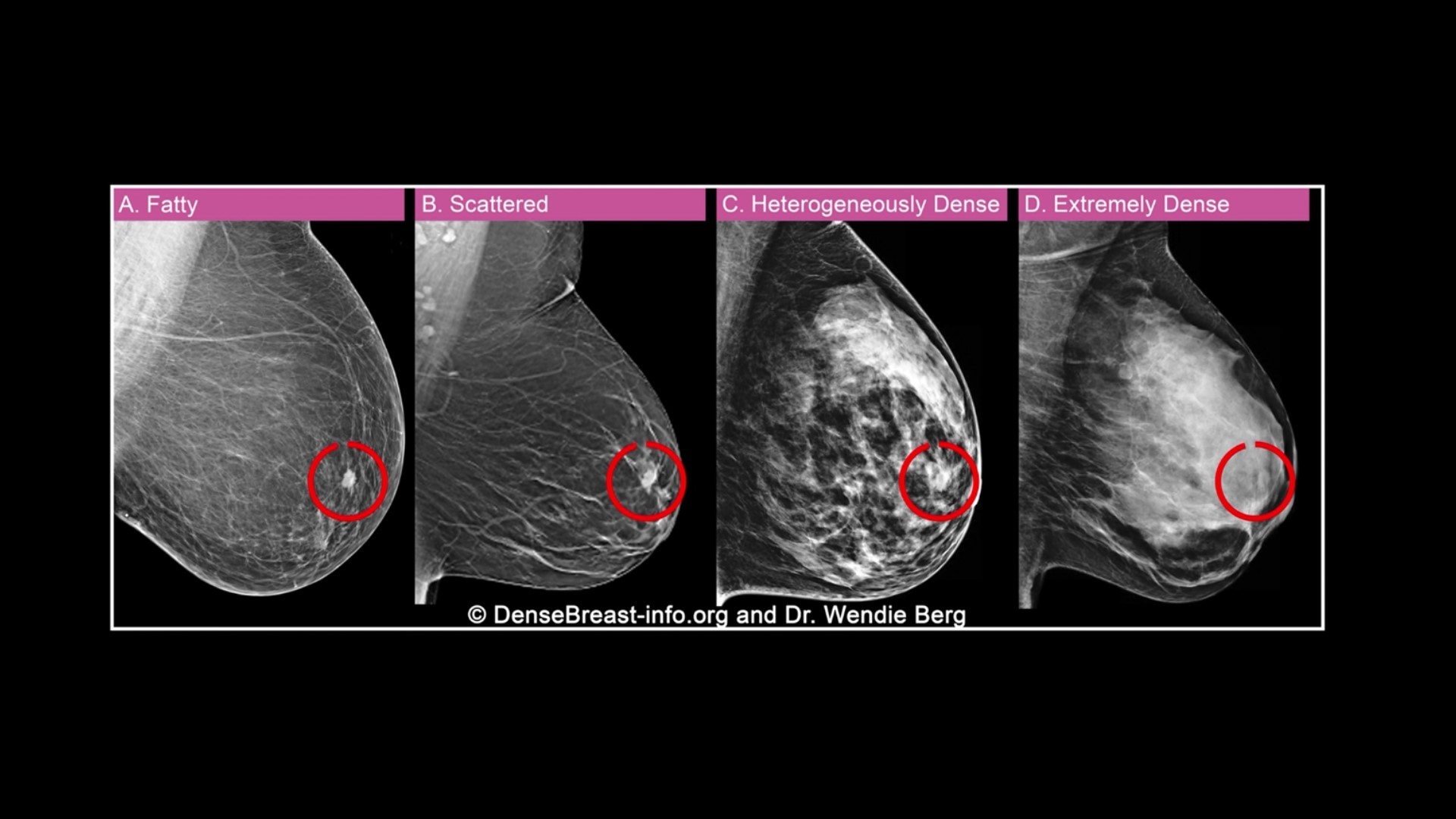 Nearly half of women 40 or older who get mammograms have dense breast tissue, according the the National Cancer Institute.