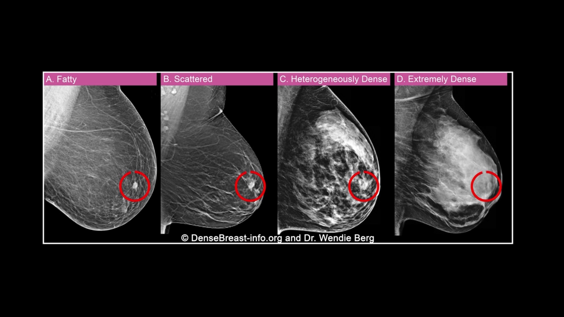 40% of Women Have a Dense Breast Tissue - Mica