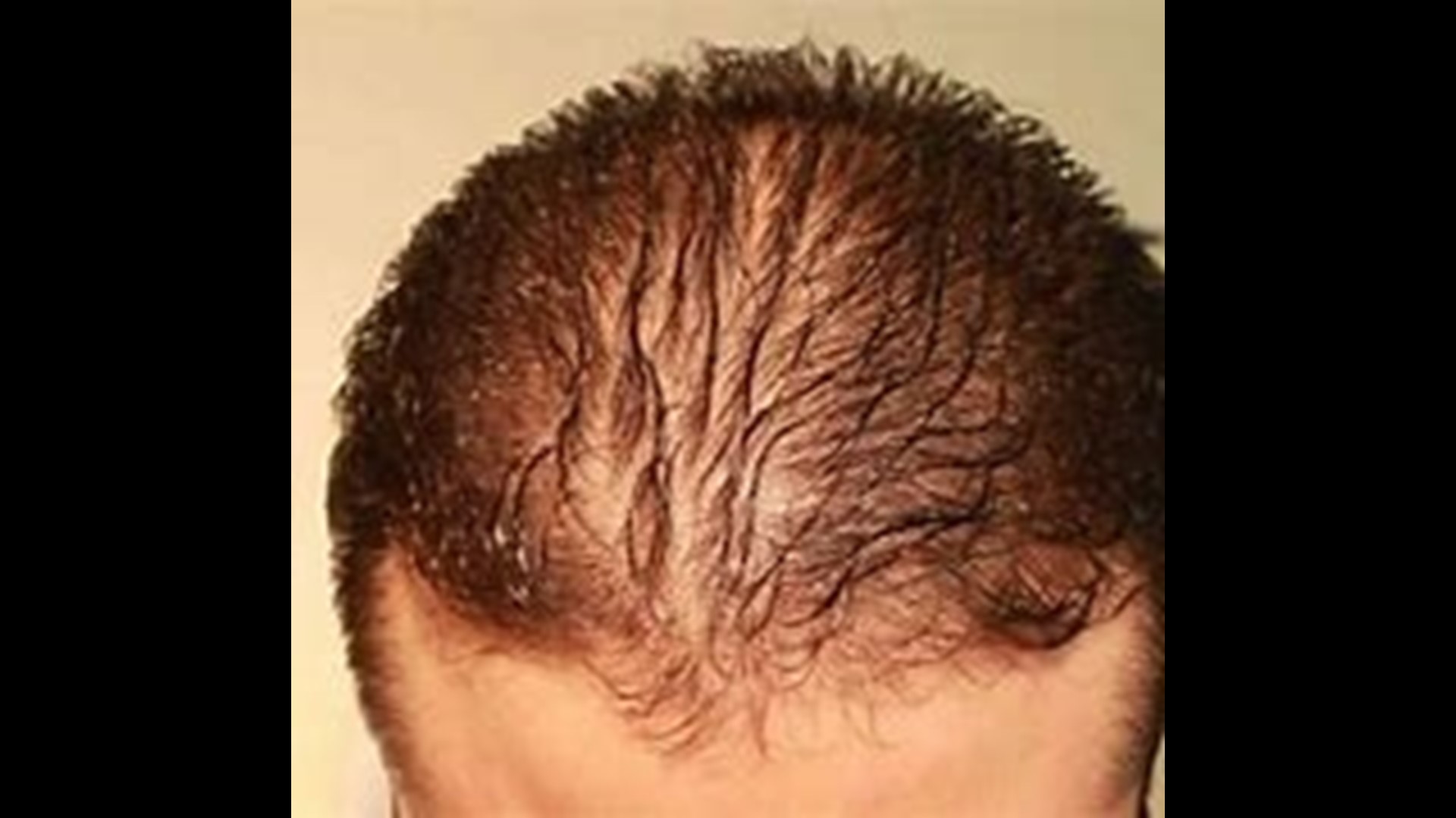Dr. Sandy Johnson says Covid, stress and poor diet all contribute.  Daren finds out how to recognize and treat hair loss.