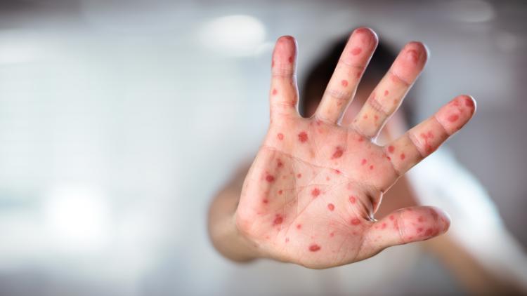 2 measles cases confirmed in Marion County, health officials say