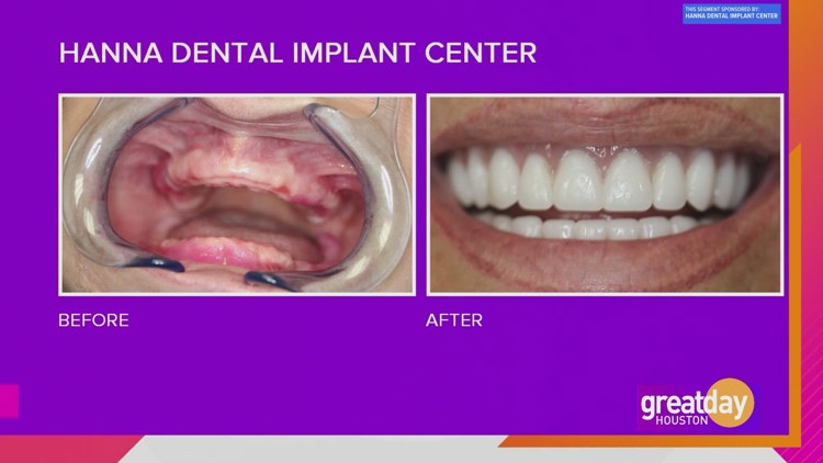 Sponsored: Change your smile, change your life with Hanna Dental Implant Center