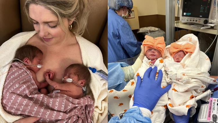 Twins survive rare condition, in-utero surgery