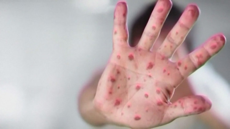 DPH reports eight new measles cases as outbreaks in South Carolina grows to 84