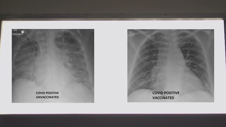 0969452a e48c 46b3 98c2 https://rexweyler.com/covid-19-lung-x-rays-show-difference-the-vaccine-can-make/