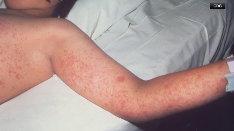 Missouri confirms 2nd case of measles since start of 2025