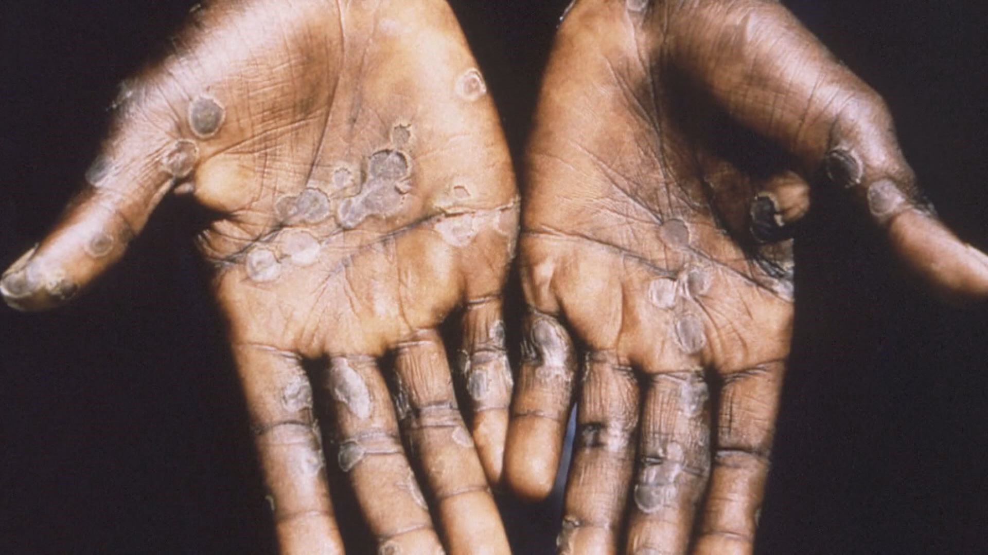 What is the state of the monkeypox outbreak in Illinois and Iowa