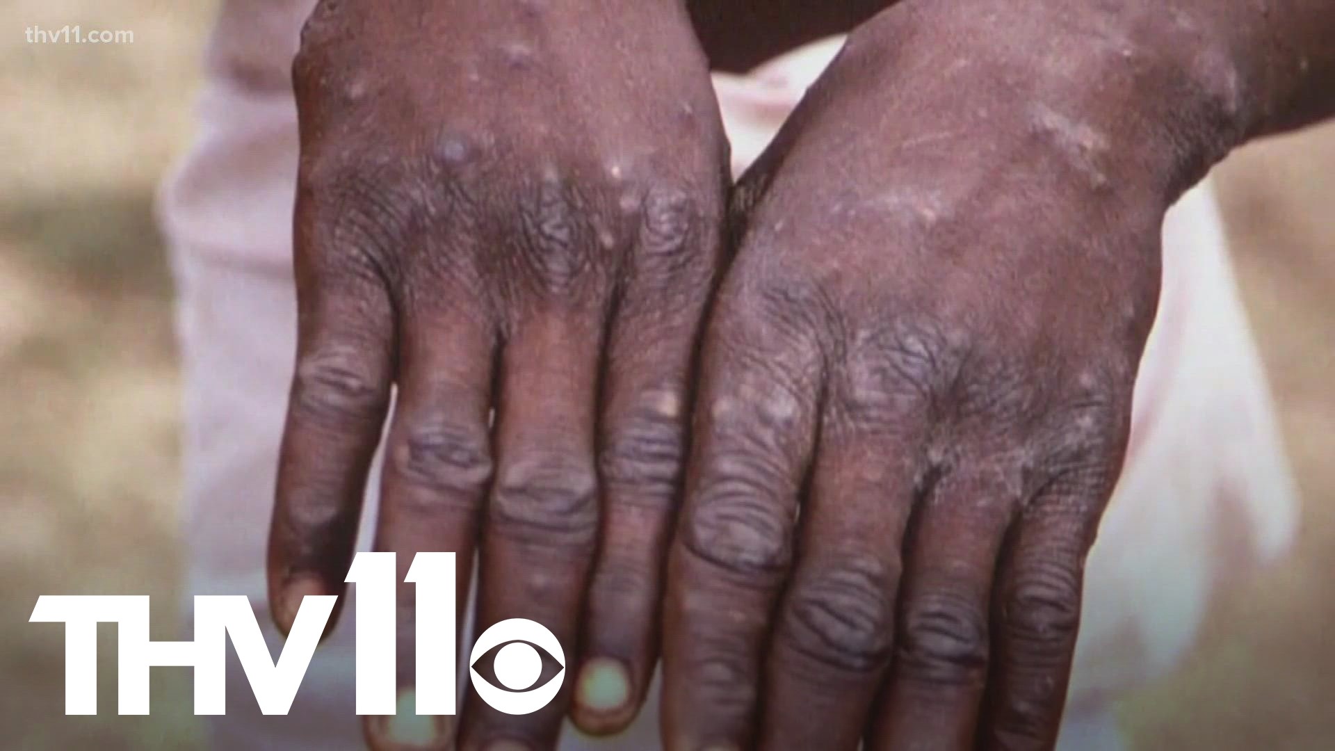 After a case of Monkeypox was confirmed in a Little Rock school, parents have been left wondering if they should be more concerned for their kids.