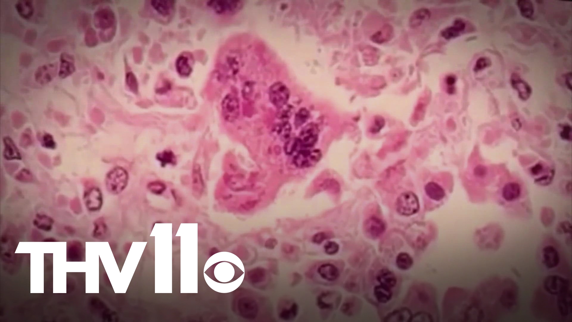 According to the Arkansas Department of Health, there have now been two confirmed pediatric cases of measles reported in the state.
