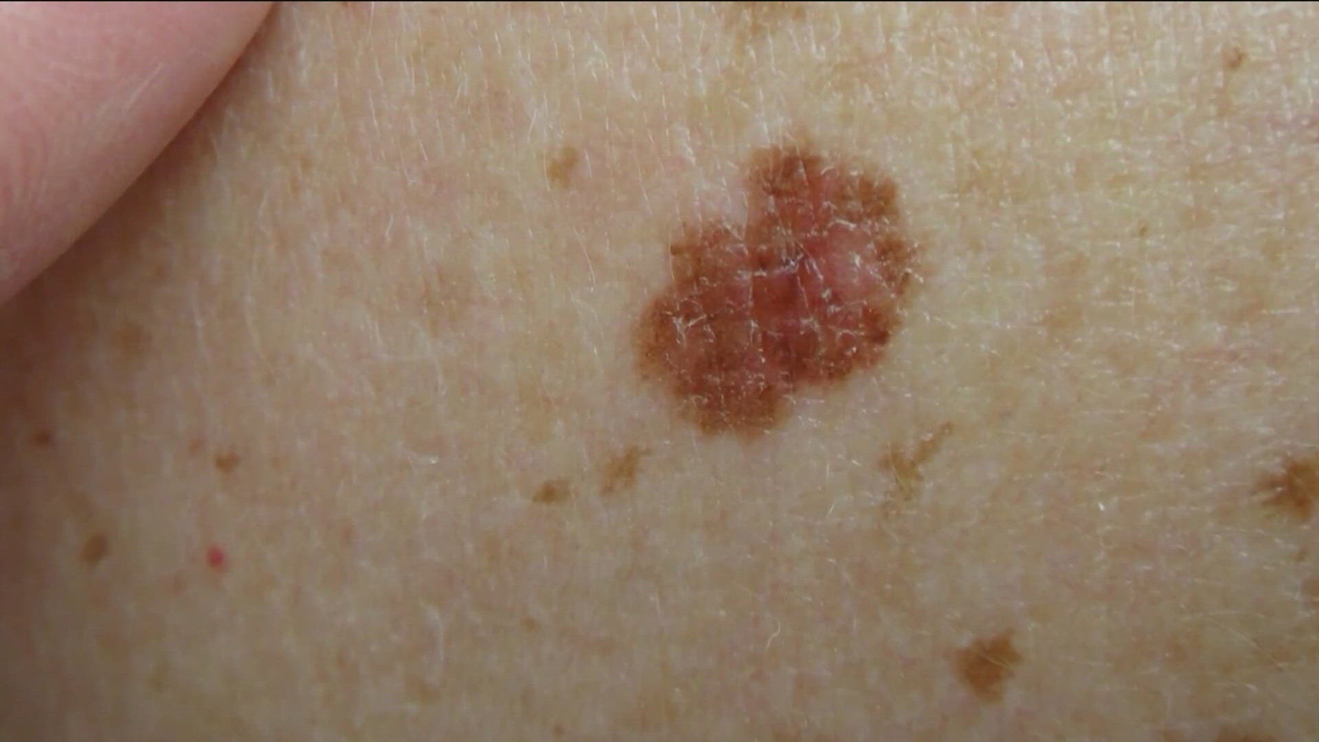 Study shows personalized mRNA vaccine cuts melanoma recurrence risk in ...