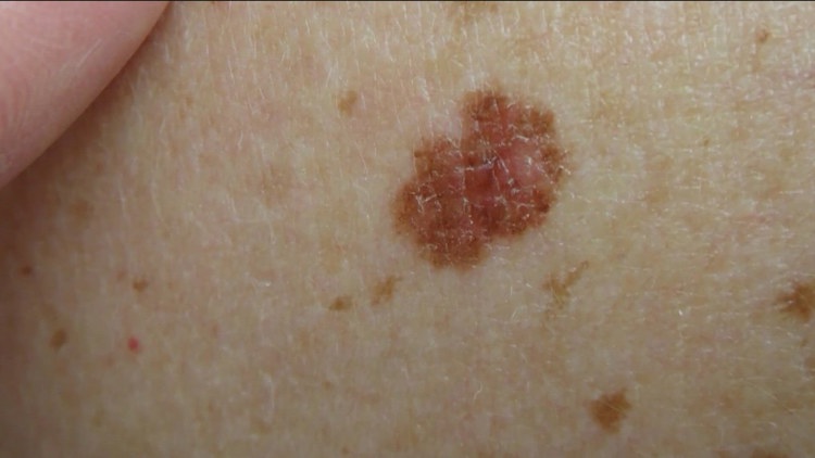 Study shows personalized mRNA vaccine cuts melanoma recurrence risk in half after five years