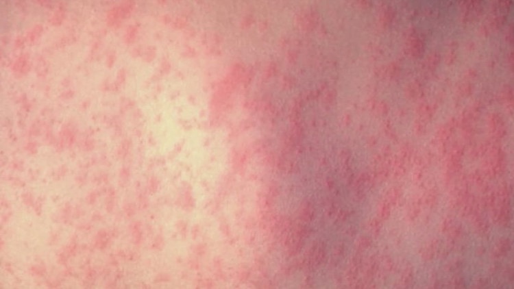 2 new measles cases confirmed in Colorado