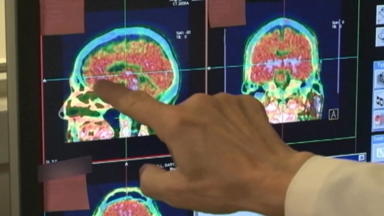 Is my child at risk for CTE? What to know about the brain disease as fall sports approach
