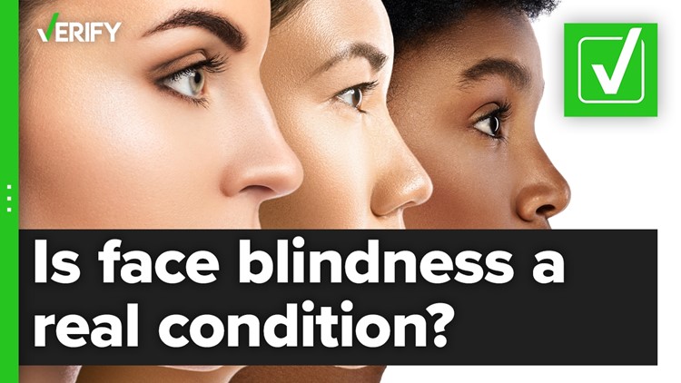 Yes, face blindness is a real condition