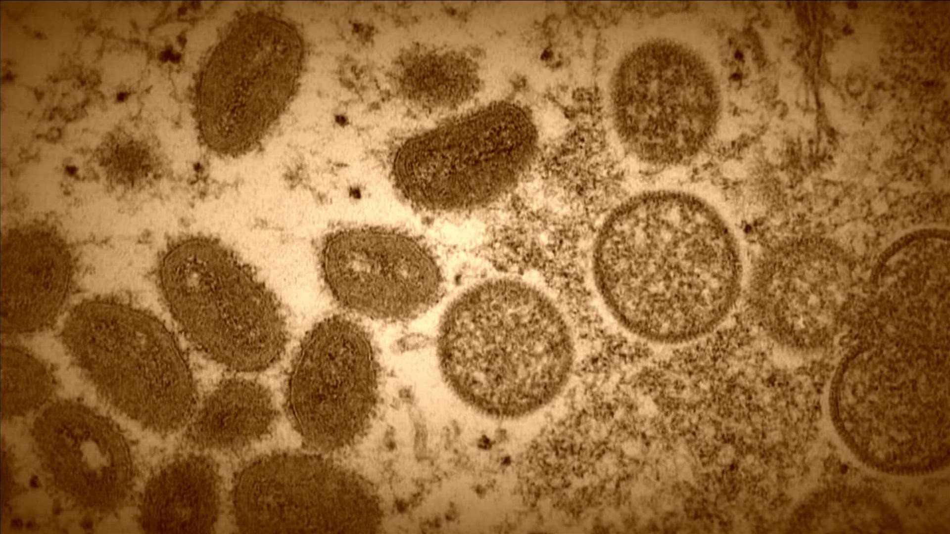 With more communities declaring health emergencies due to monkeypox, we wanted to know what Shelby County residents could do to fight the disease.