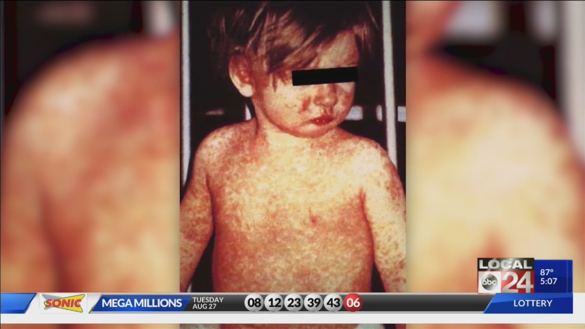 CDC: “Reasonable chance” U.S. will lose measles elimination status