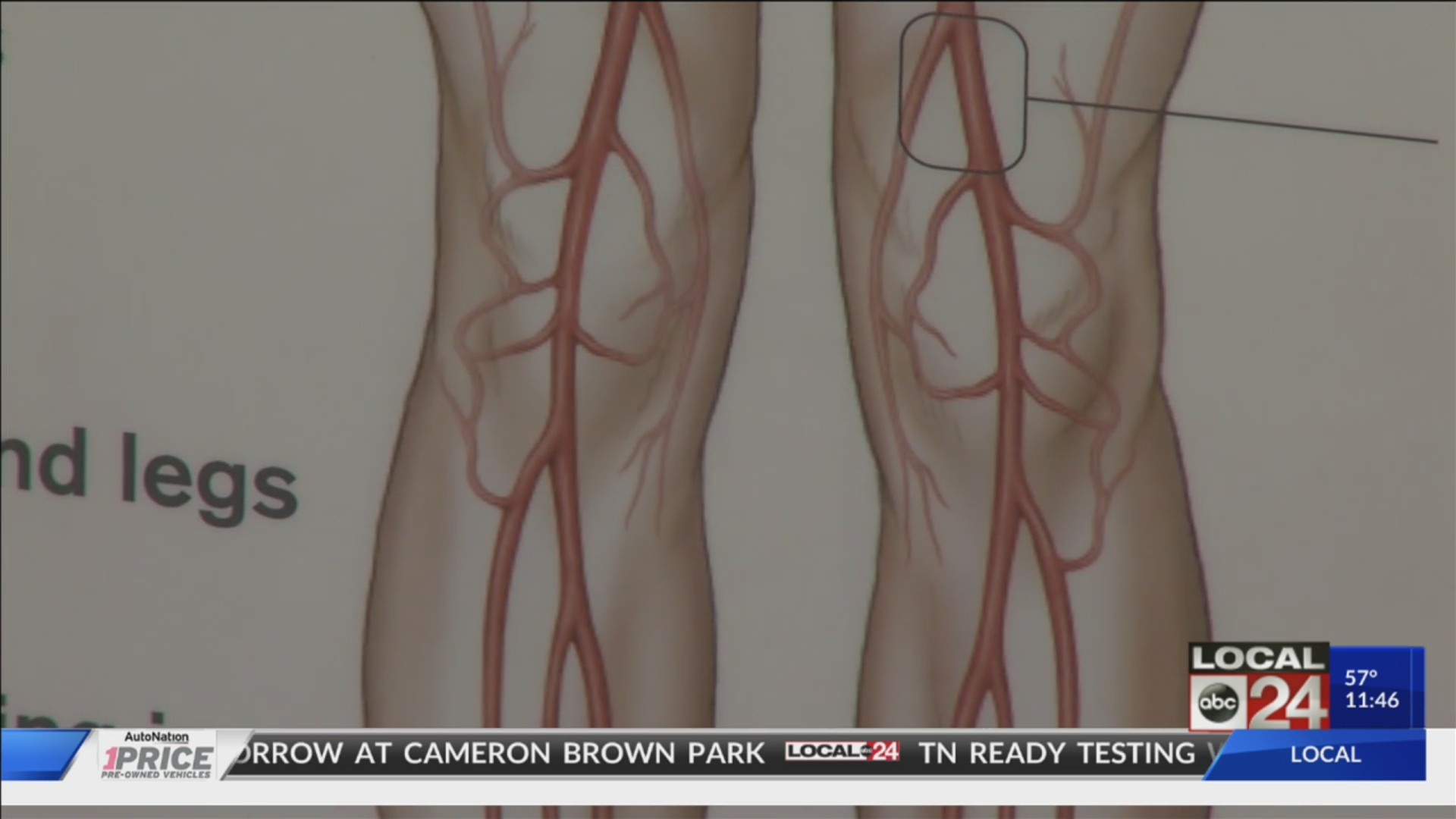 Local Health Alert: Wound Healing & Limb Preservation