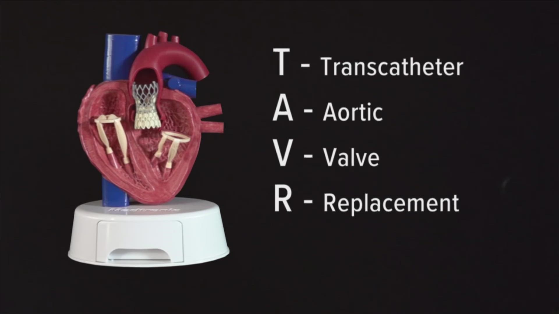 Saint Francis Hospital is helping patients using TAVR (Trans Aortic Valve Replacement), which repairs Aortic Stenosis, a hardening of the aortic valve.
