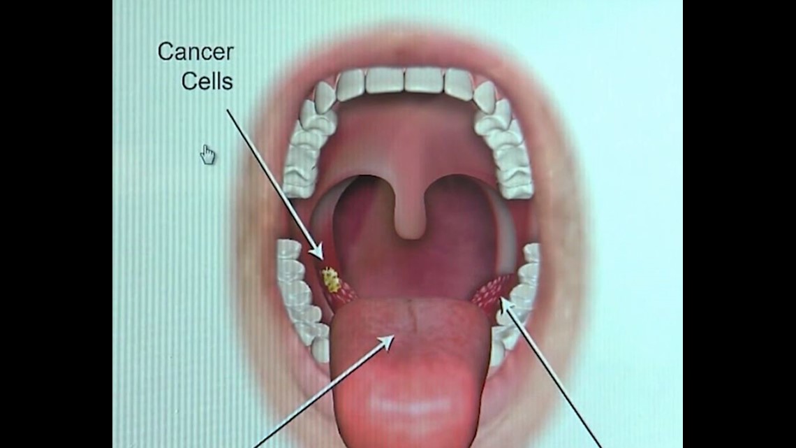 throat cancer from hpv cum vă puteți infecta cu verucile genitale