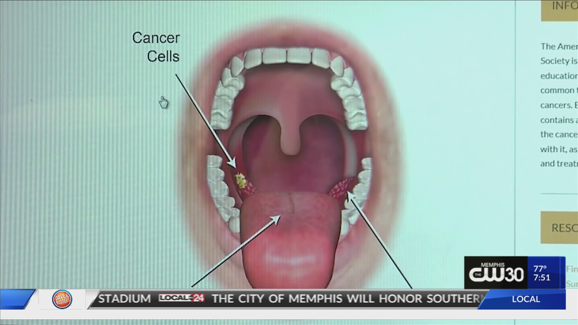 throat cancer by hpv)