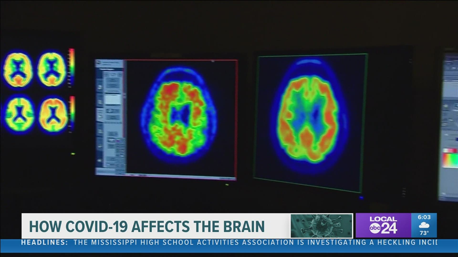 “The neurological stuff can be quite attention-getting for people,” said Dr. Stephen Threlkeld, Baptist Memorial Hospital Infectious Disease Medical Doctor.