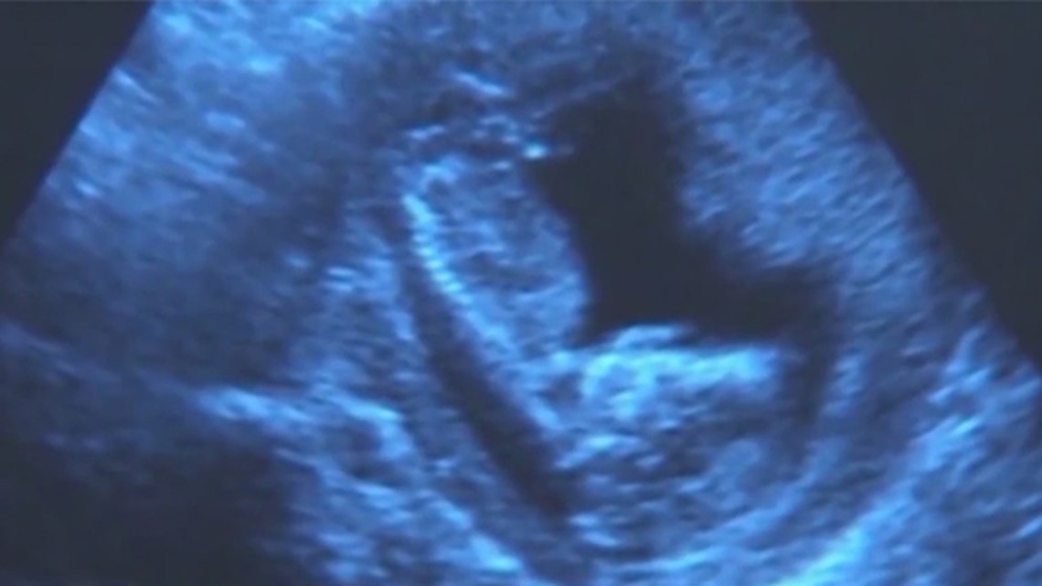 Sponsor of Iowa House bill banning all abortions cancels subcommittee meeting, ending effort